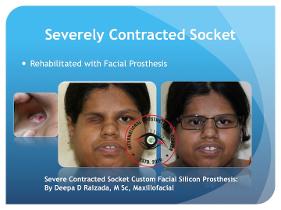 Silicone Facial Prosthesis for a contracted socket