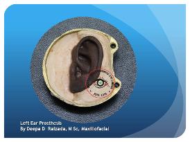 Silicone Ear Prosthesis