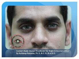 Custom Made Artificial Eye Fitted Over Enucleated Eye Artificial Eye Before & After Results