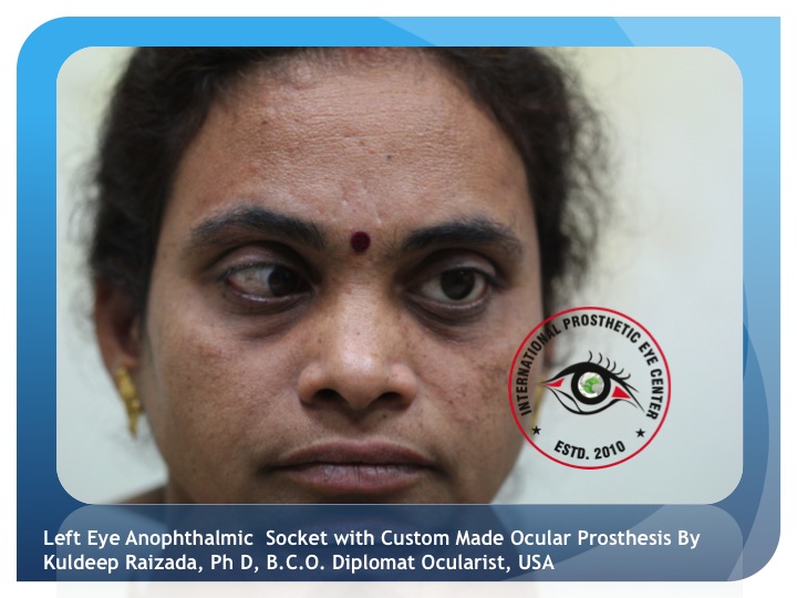 Ocular Prosthetics: Custom-Made Prosthetic Eyes