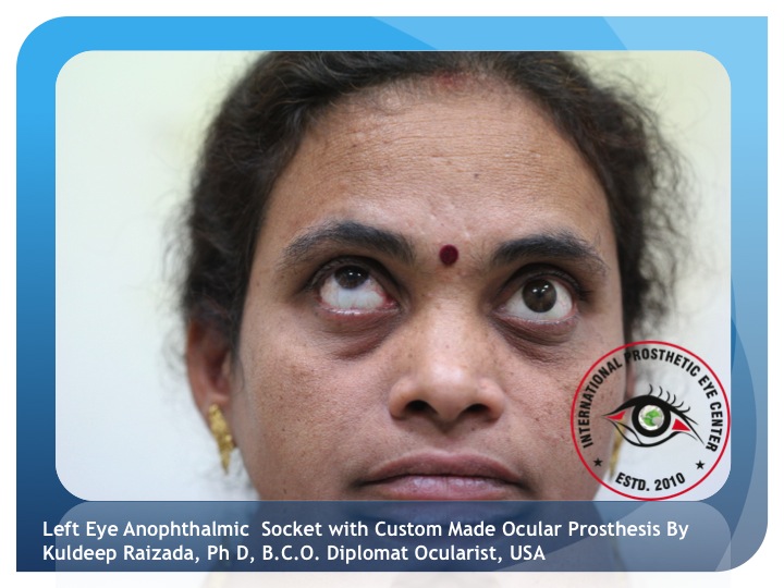 Custom Artificial Eyes at best price in Hyderabad by Akriti Business  Creations