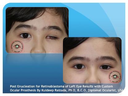 Post Retinoblastoma