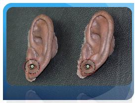 Silicone Ear Prosthesis India