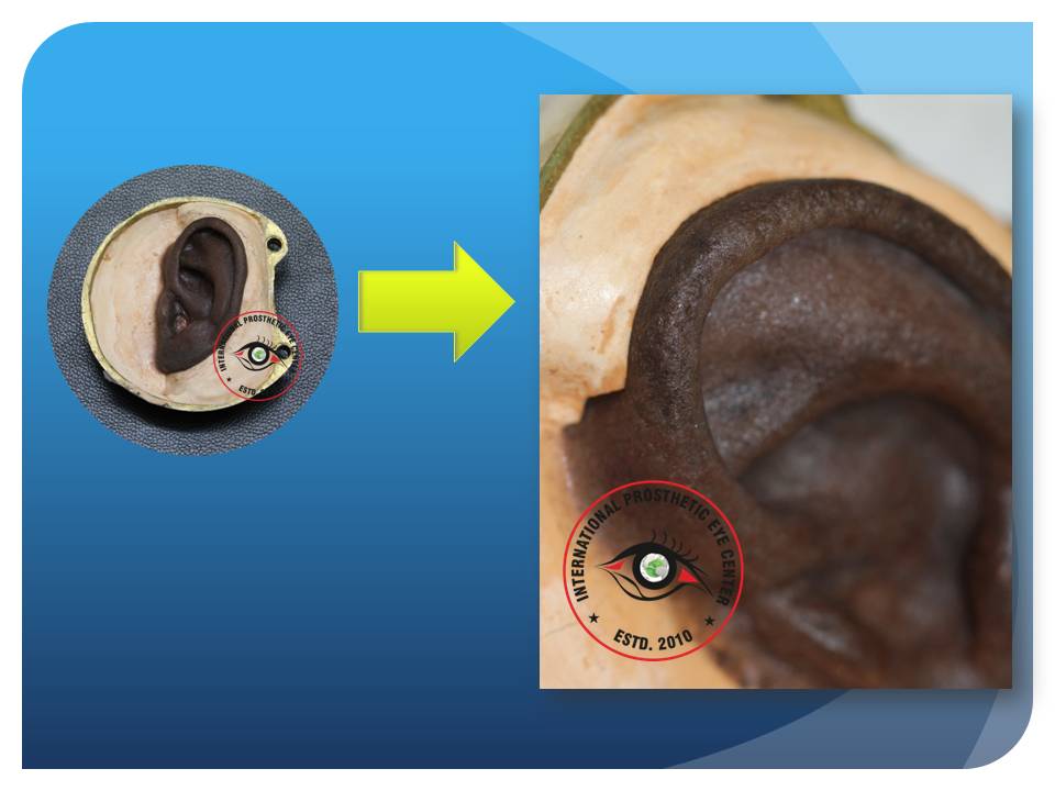 Fabrication Technique of ear prosthesis