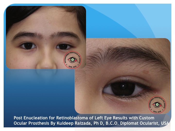 Custom Artificial Eyes at best price in Hyderabad by Akriti Business  Creations