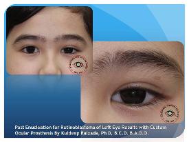 Life Like Artificial Eye for Retinoblastoma Survivor