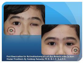 Natural Appearance with Custom Made Artificial Eye Before & After Results