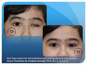 Artificial Eye for Retinoblastoma Survivor
