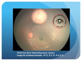 Retinoblastoma Eye