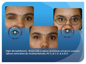 Microphthalmia/anophthalmia Patient fitted with a custom artificial eye