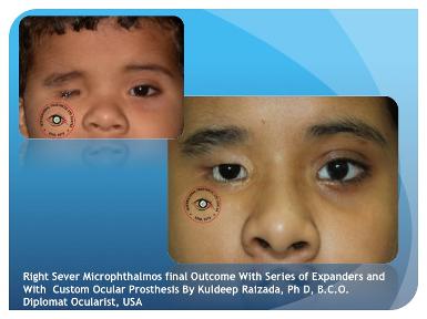 Congenital Microphthalmic eye with Cosmetic Eye and Cosmetic Correction with Glasses
