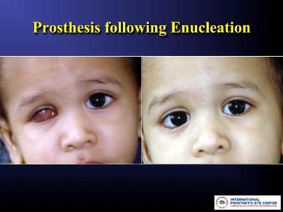 Post Enucleation with right Custom ocular prosthesis