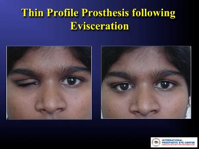 Evisceration with Implant, Following Custom Artificial Eyes